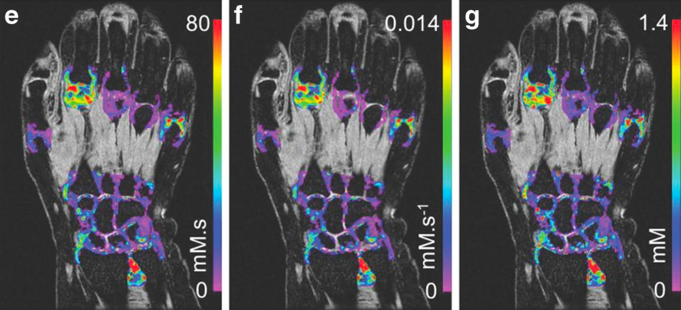 MRI of the joint and evaluation of the granulocyte-macrophage colony-stimulating factor--CCL17 axis in patients with rheumatoid arthritis receiving otilimab: a phase 2a randomised mechanistic study
