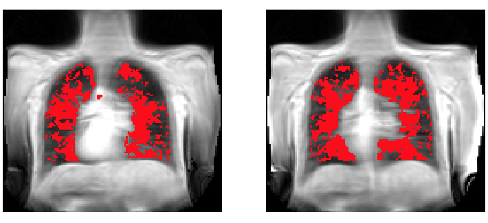 Feasibility of dynamic T2*-based oxygen-enhanced lung MRI at 3T
