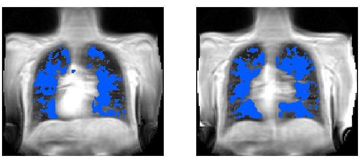Independent component analysis applied to dynamic oxygen-enhanced MRI for robust functional lung imaging at 3T