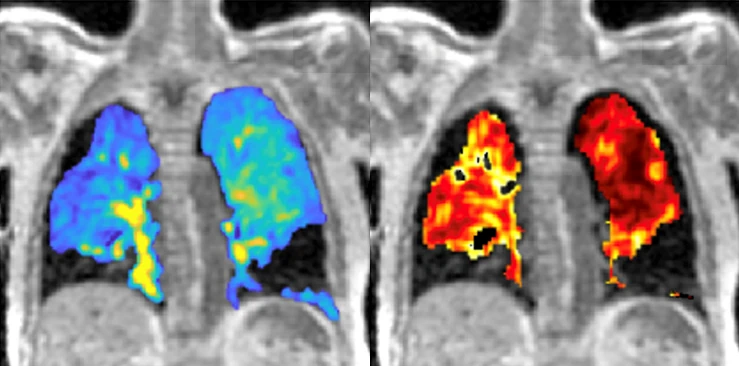 Imaging biomarkers of lung ventilation in interstitial lung disease from 129Xe and oxygen-enhanced 1H MRI